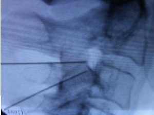 Dor Cervical (Pescoço) provocada por traumatismo (Golpe do Chicote ou Whilplash)