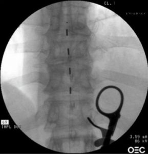 Eletrodo SCS introduzido no espaço epidural torácico inferior para tratamento paliativo da dor da raiz nervosa após uma hérnia discal lombar que não melhorou após a cirurgia
