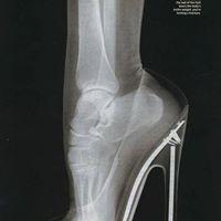 Fasceite Plantar