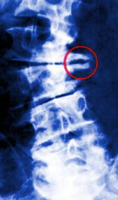 Bico-de-Papagaio-Osteofitos