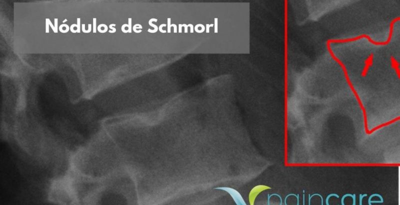 Nodulos-de-Schmorl