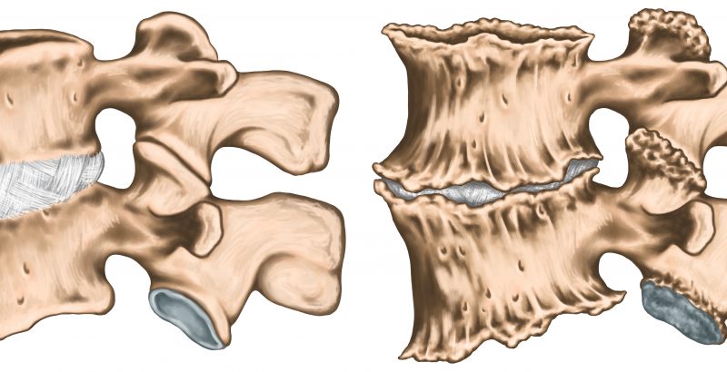 Osteofitos